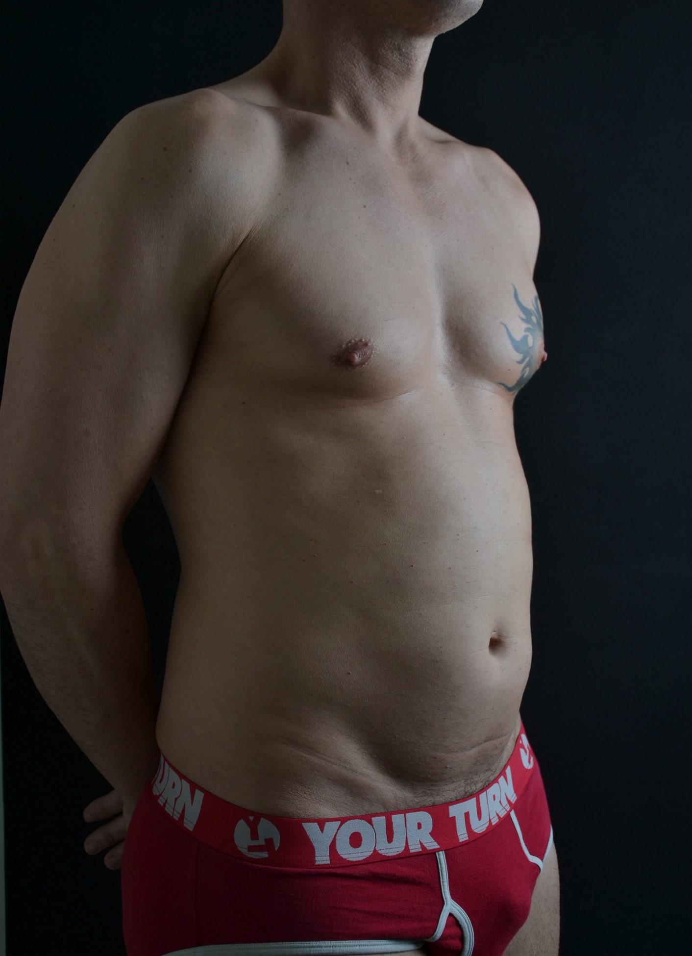 Lipoescultura de alta definición en hombres - antes