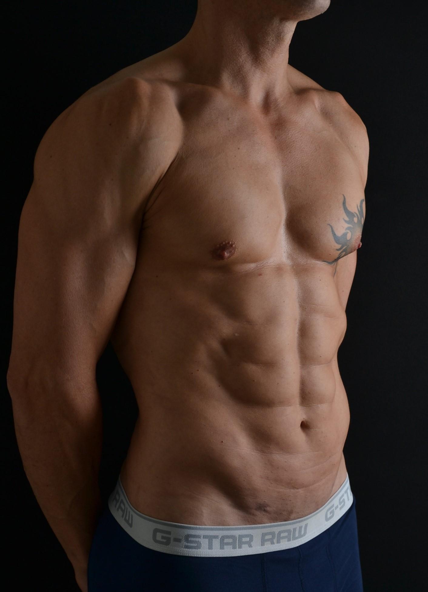 Lipoescultura de alta definición en hombres - después