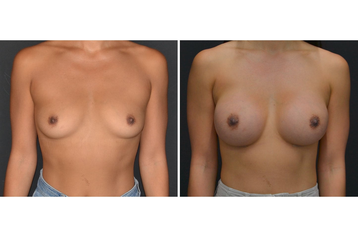 gallery-ba-breast-aug-a1