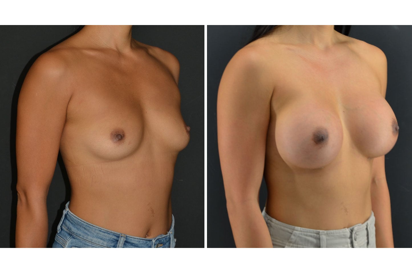 gallery-ba-breast-aug-a3