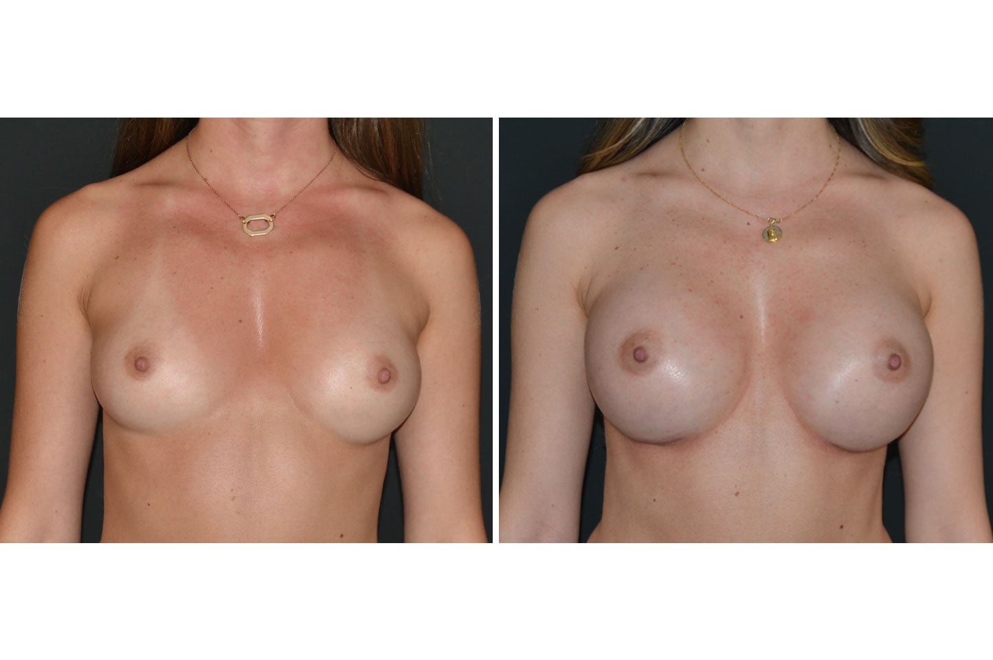 gallery-ba-breast-aug-b1