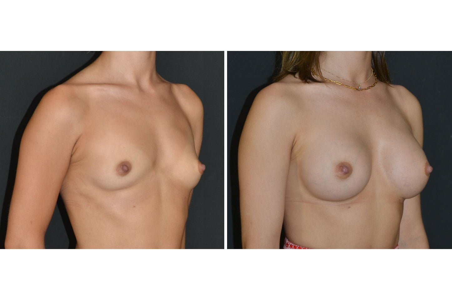 gallery-ba-breast-aug-c1