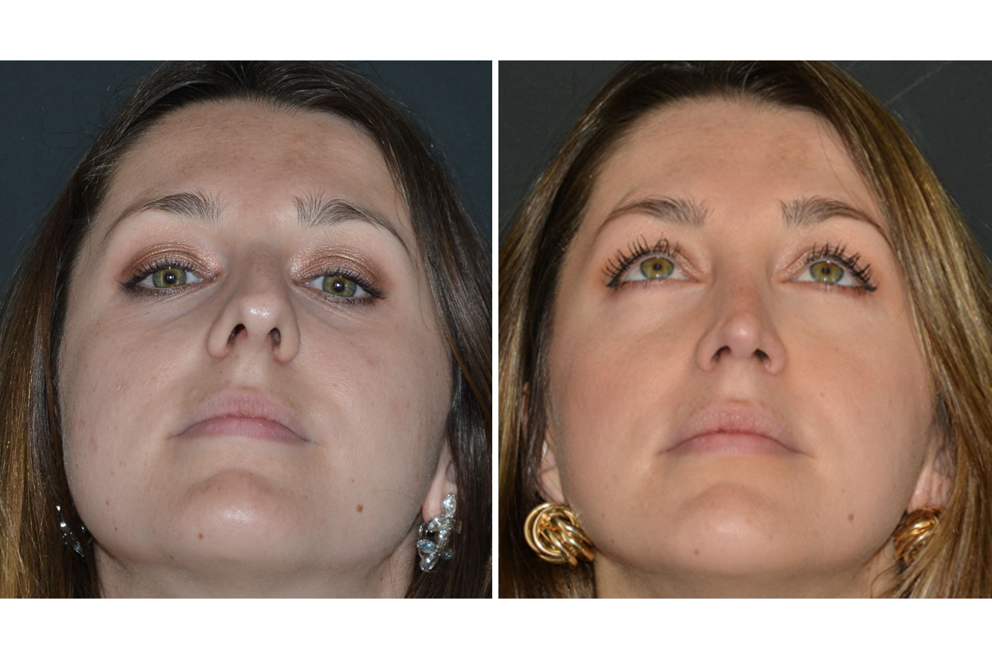 gallery-ba-rhinoplasty-a2