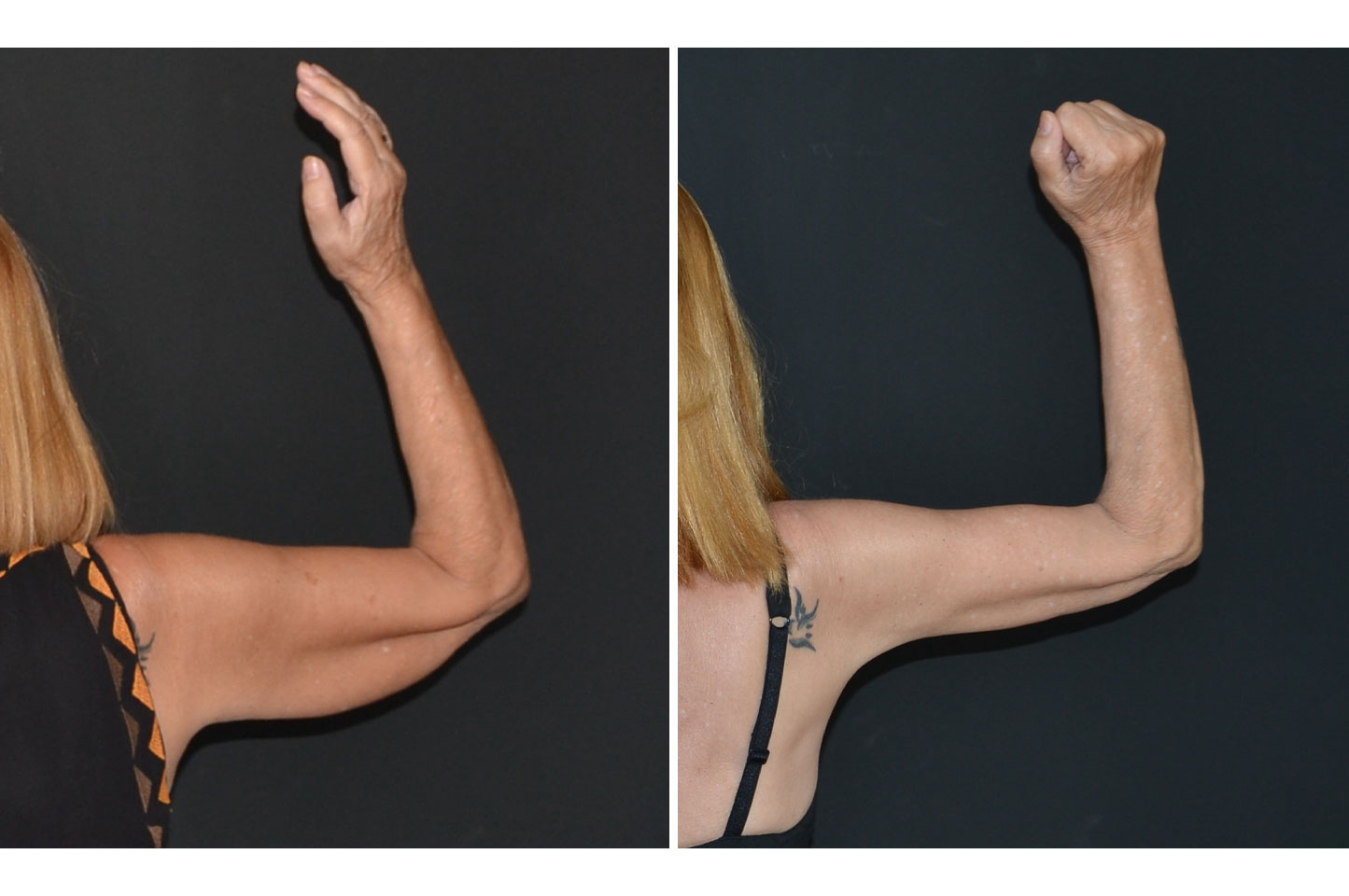 gallery-body-lift-a1