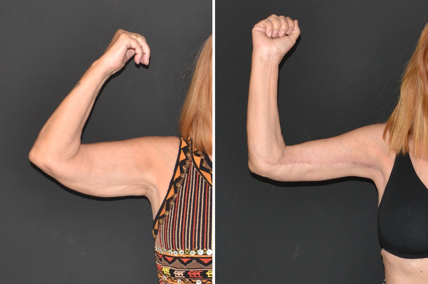 gallery-body-lift-a2