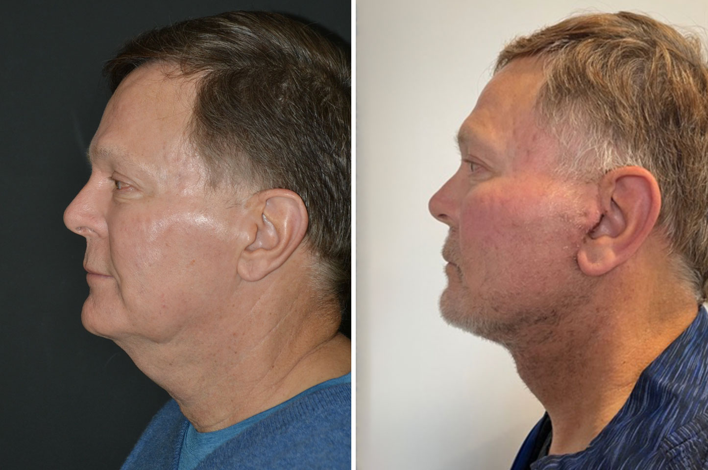 imagn-ba-neck-facelift-a1