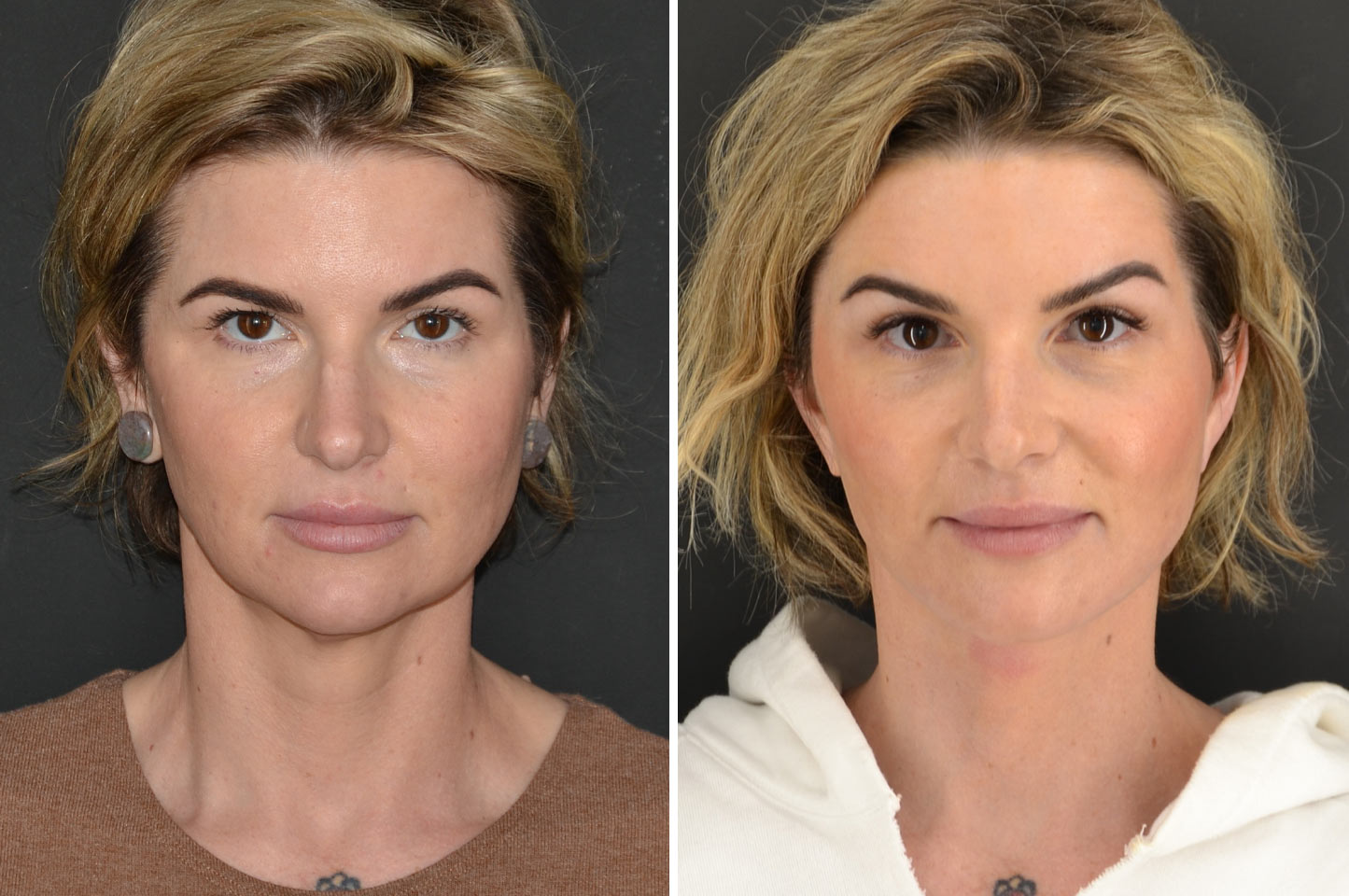 imagn-ba-neck-facelift-a2