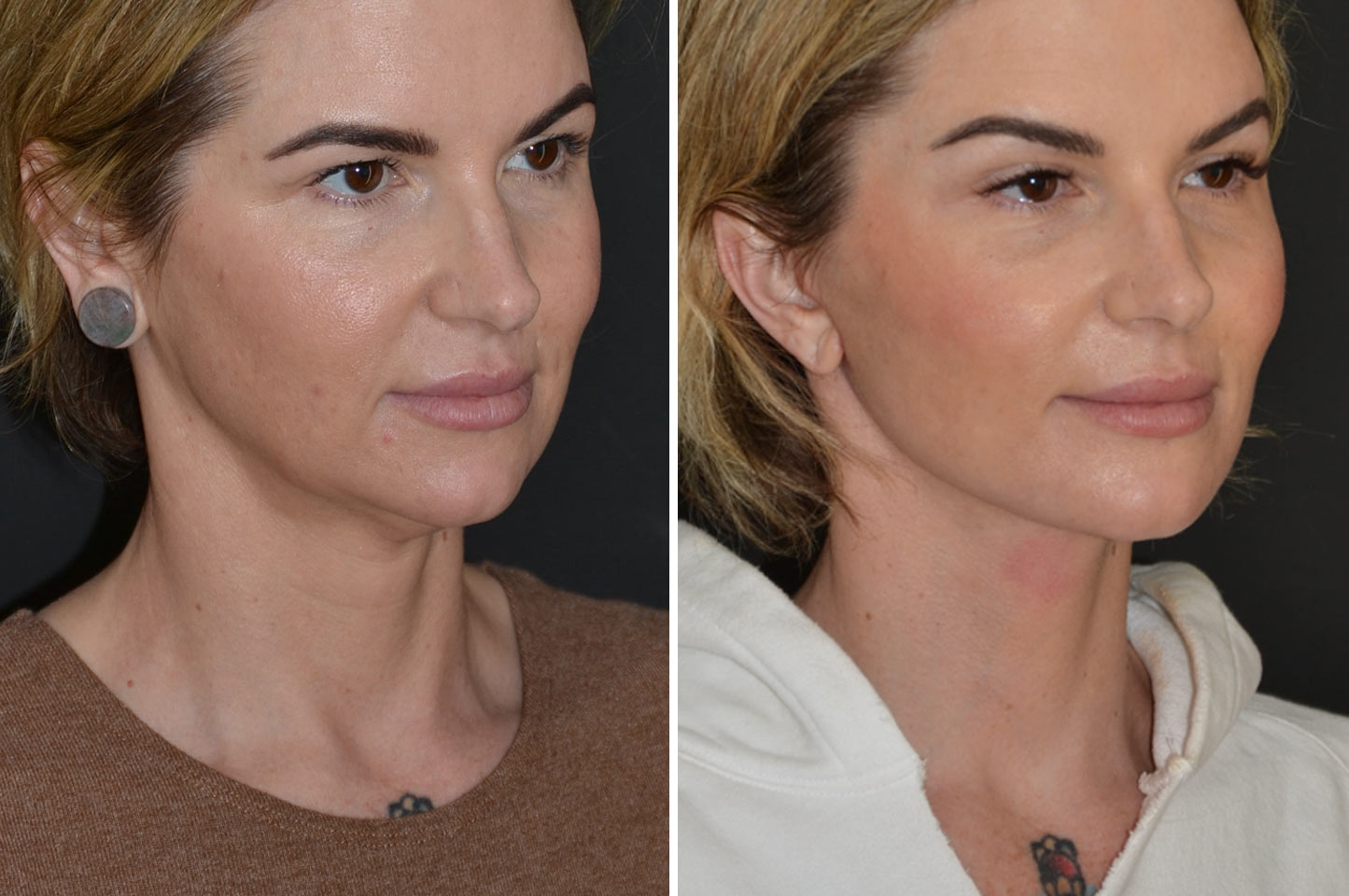 imagn-ba-neck-facelift-a3
