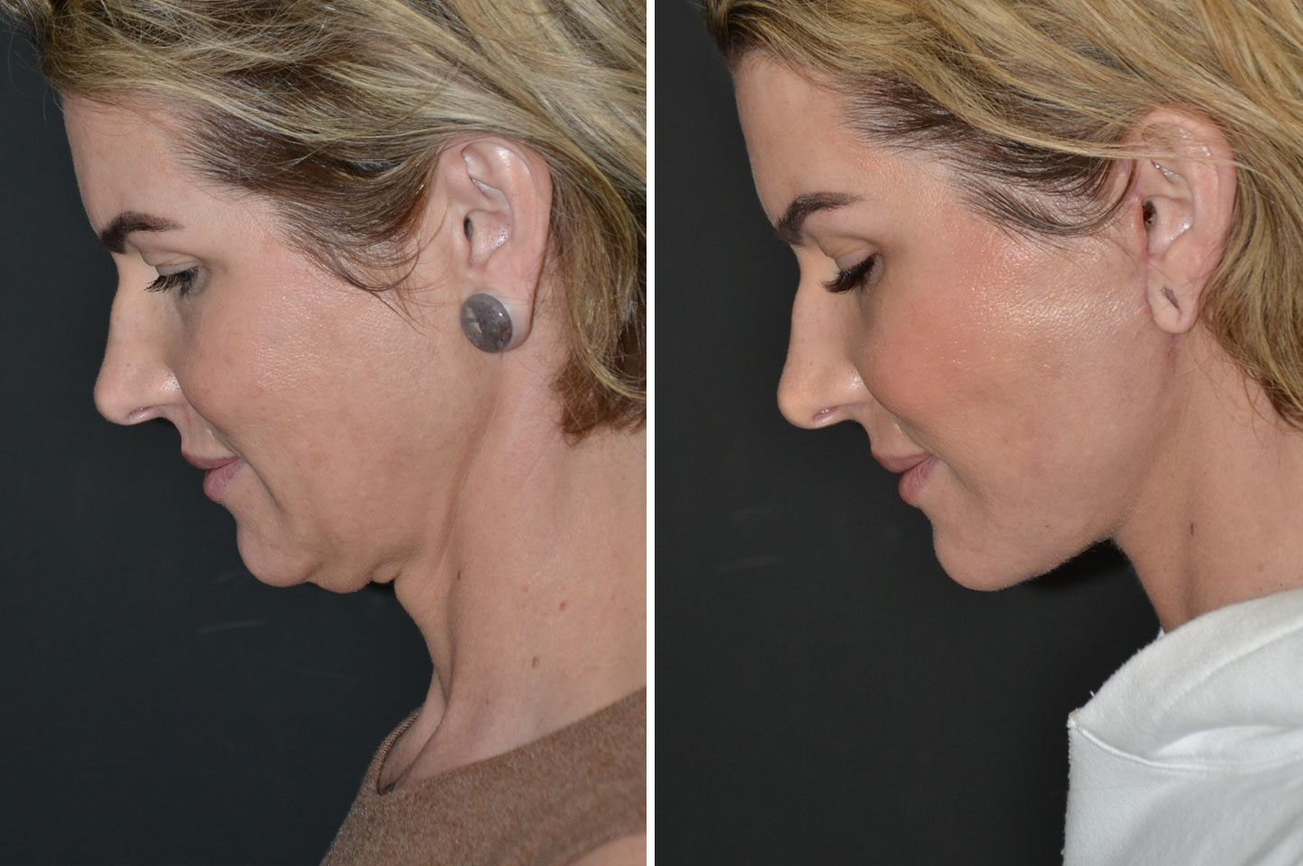 imagn-ba-neck-facelift-a4