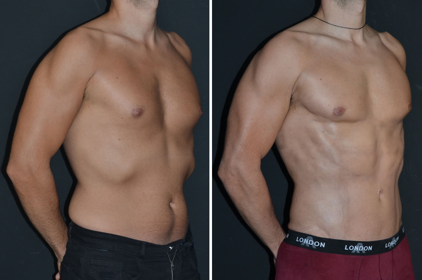 PAL® High Definition Liposculpture imagn-pal-ba-1