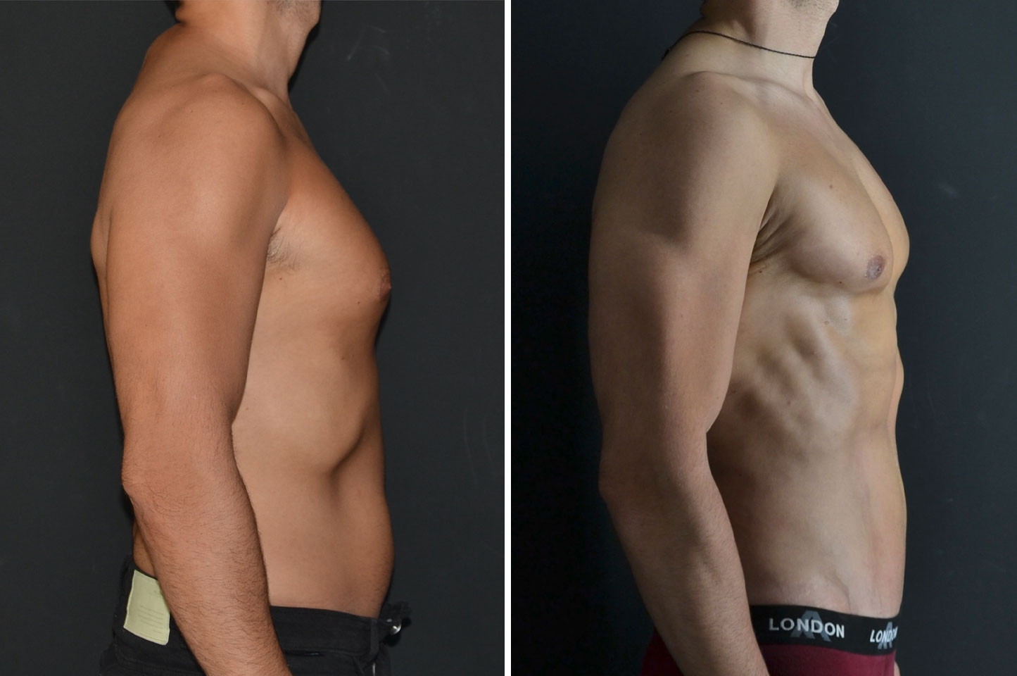 PAL® High Definition Liposculpture imagn-pal-ba-2