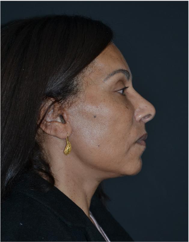 Lifting facial - después