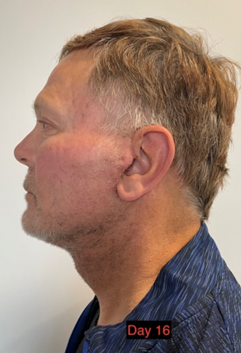 Lifting facial en hombres - después