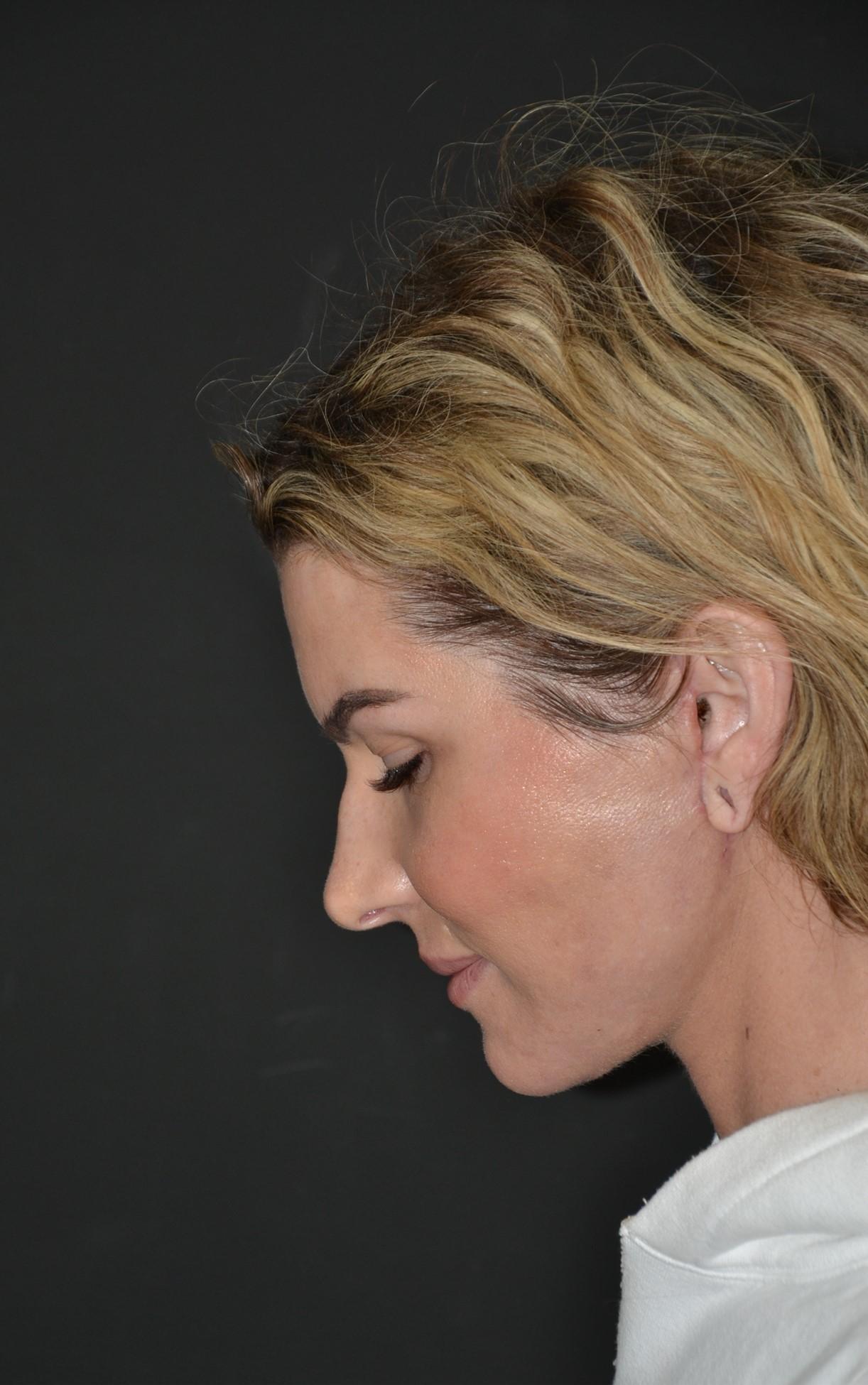 Lifting facial en mujer - después