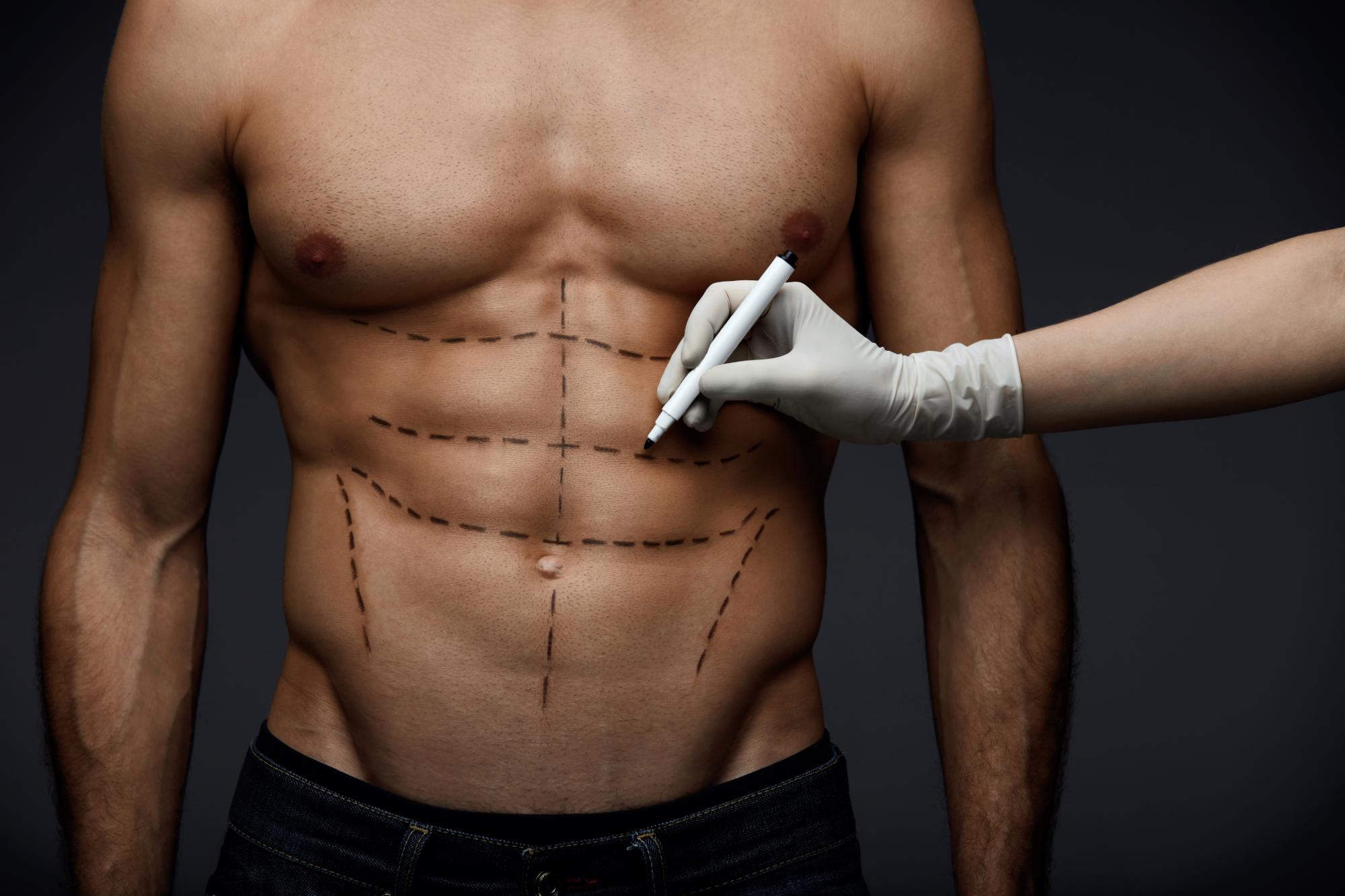 Blog Tipos de liposucción