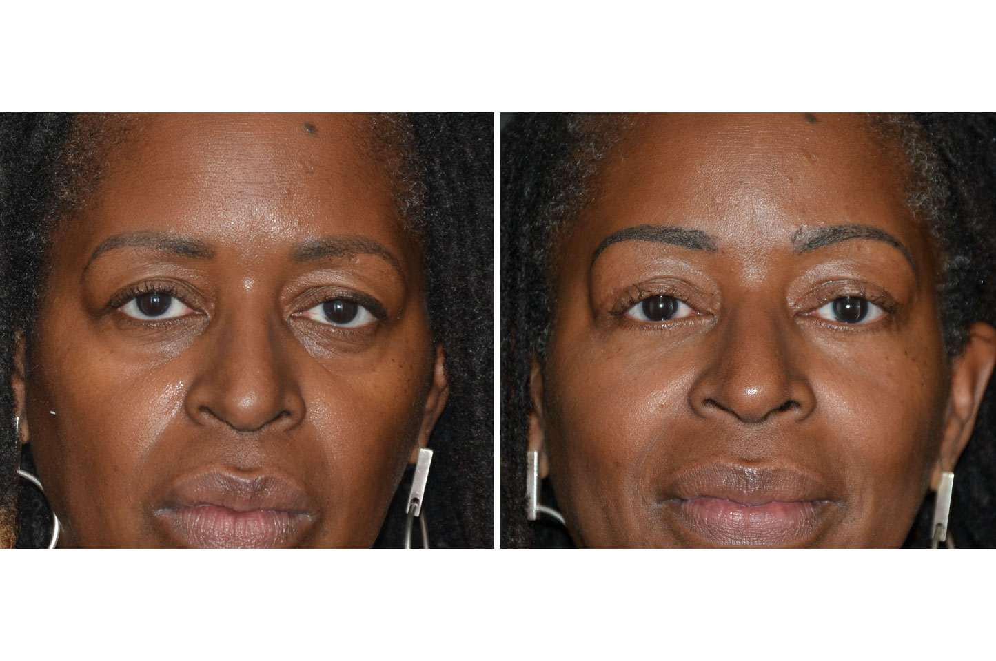gallery-brow-lift-a12