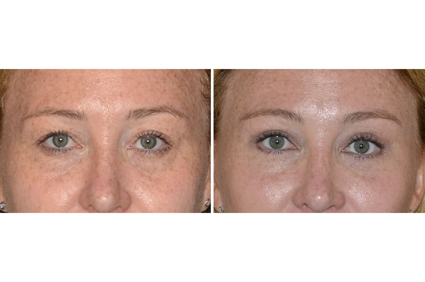 gallery-brow-lift-b1