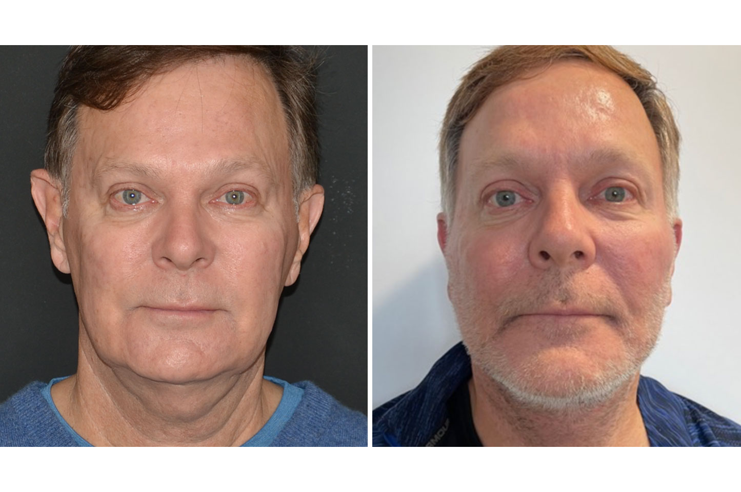 gallery-face-necklift-a2