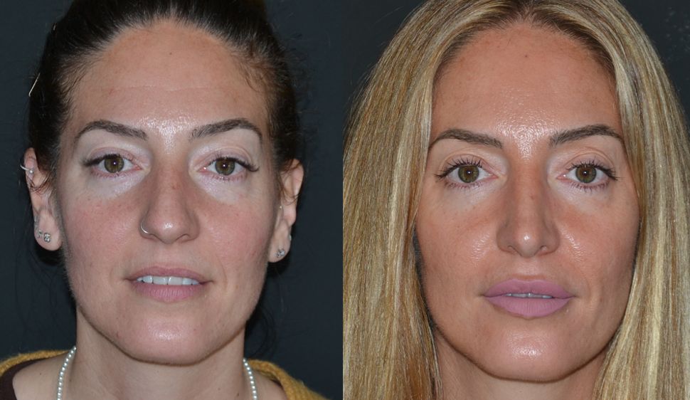Blog Recuperación después de una rinoplastia