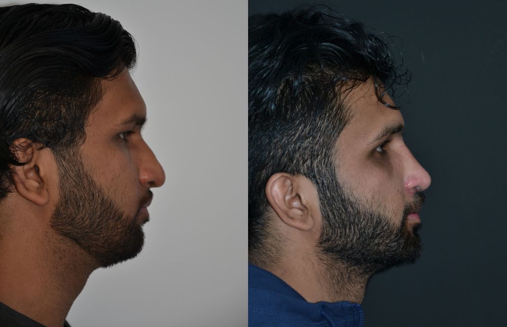 Blog Rinoplastia en hombres
