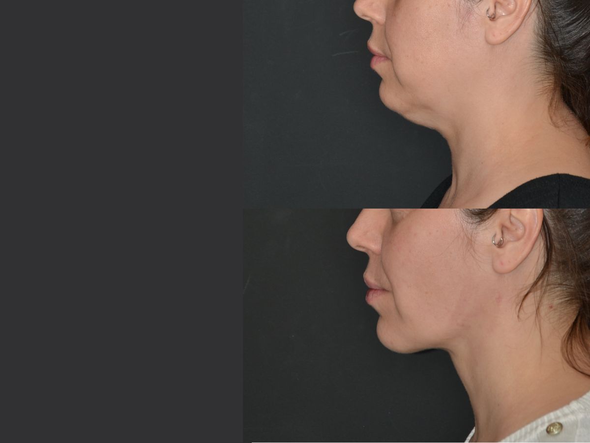 Blog Neck sagging