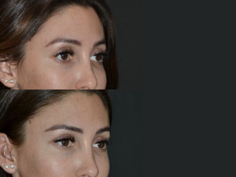 Foxy eyes cirugia