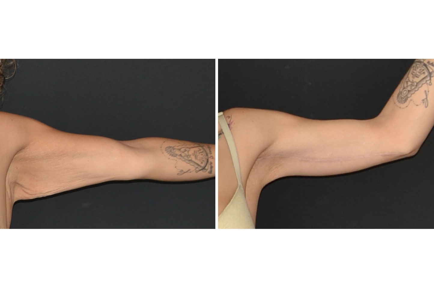 brachioplasty-a1