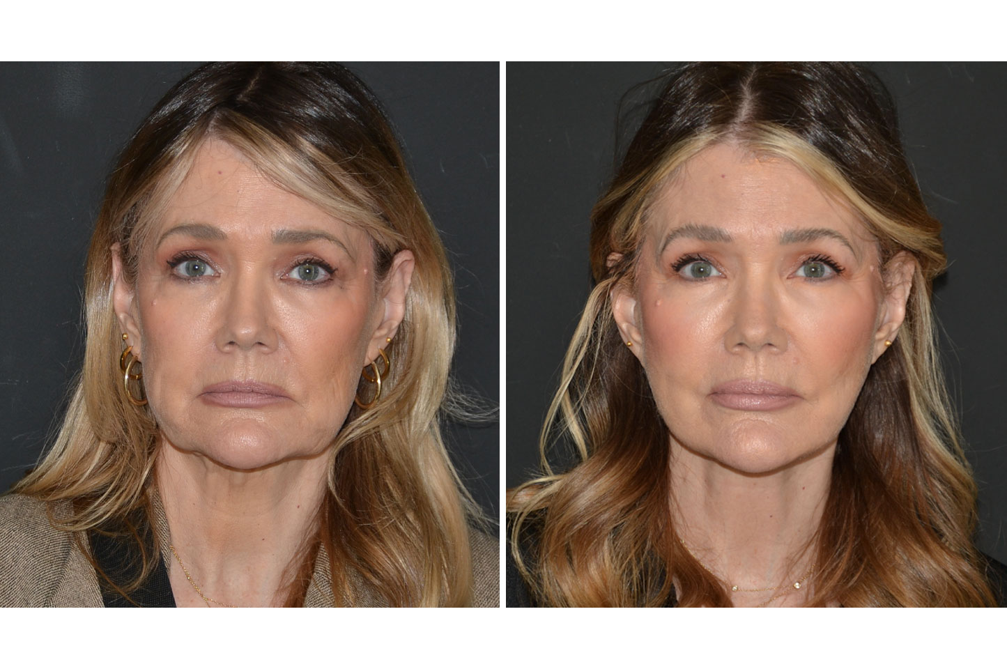 deep-plane-facelift-a1