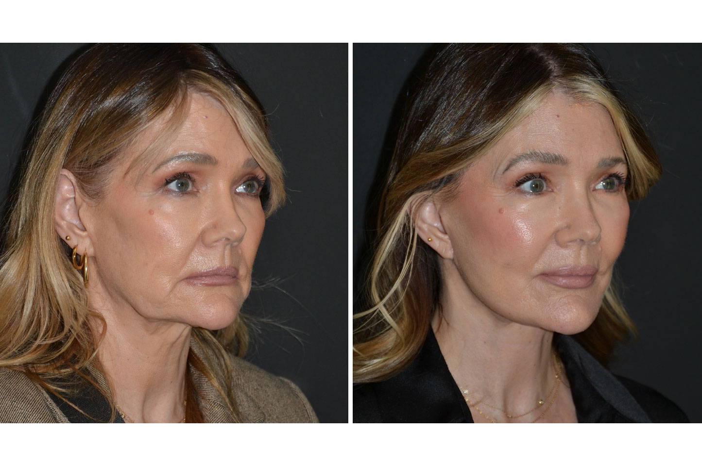 deep-plane-facelift-a4