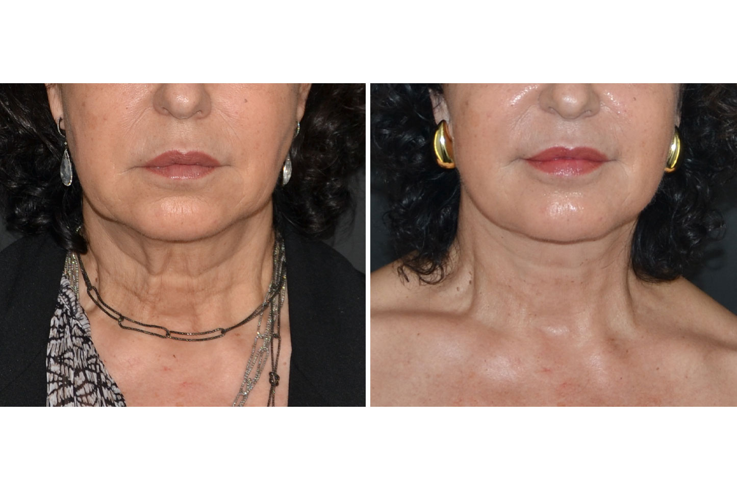 deep-plane-facelift-c1