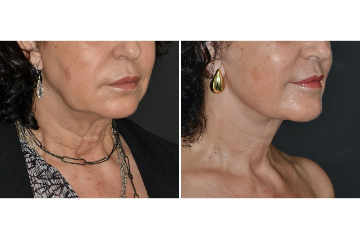 deep-plane-facelift-c2