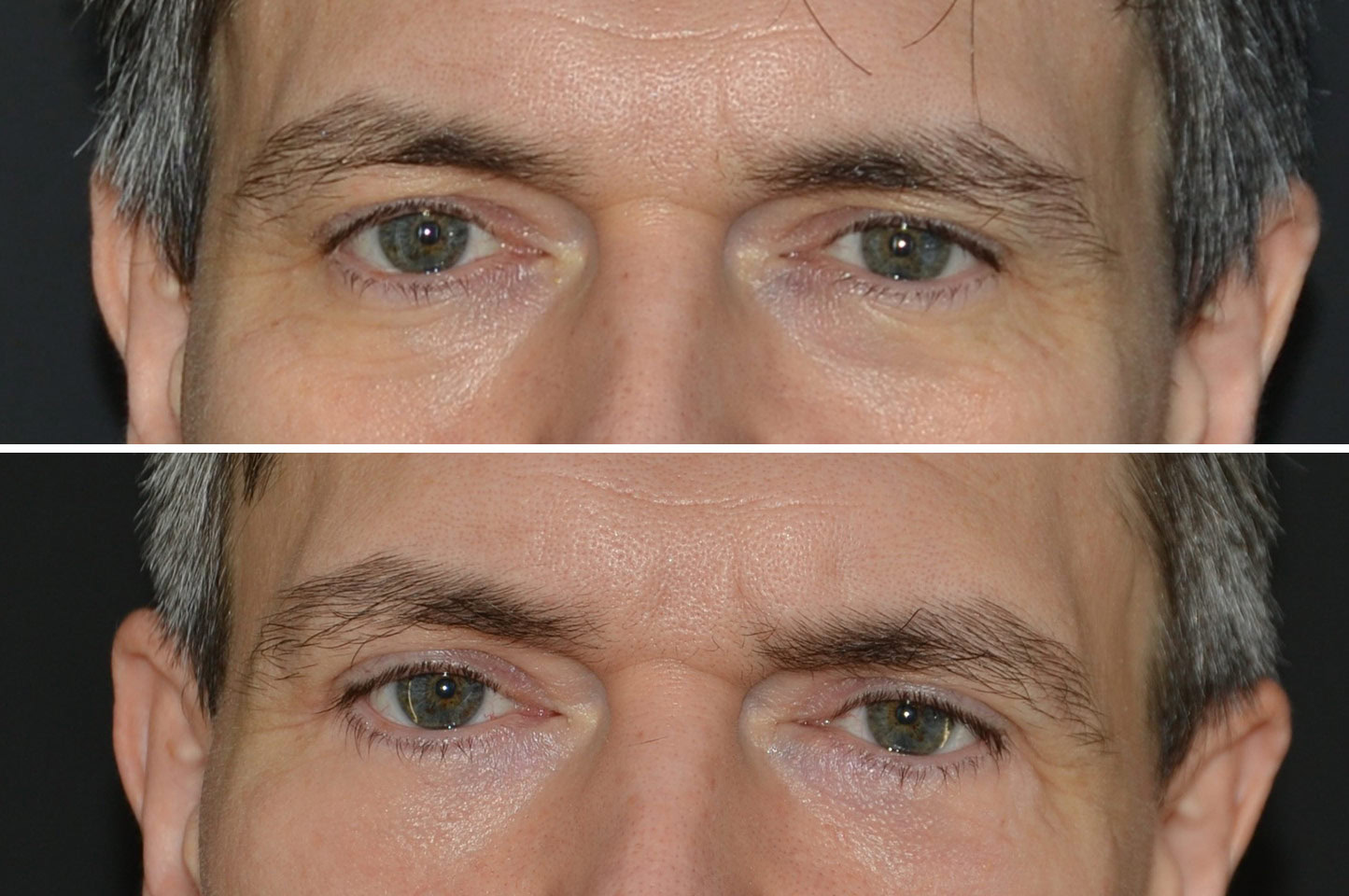 gallery-blepharoplasty-a1