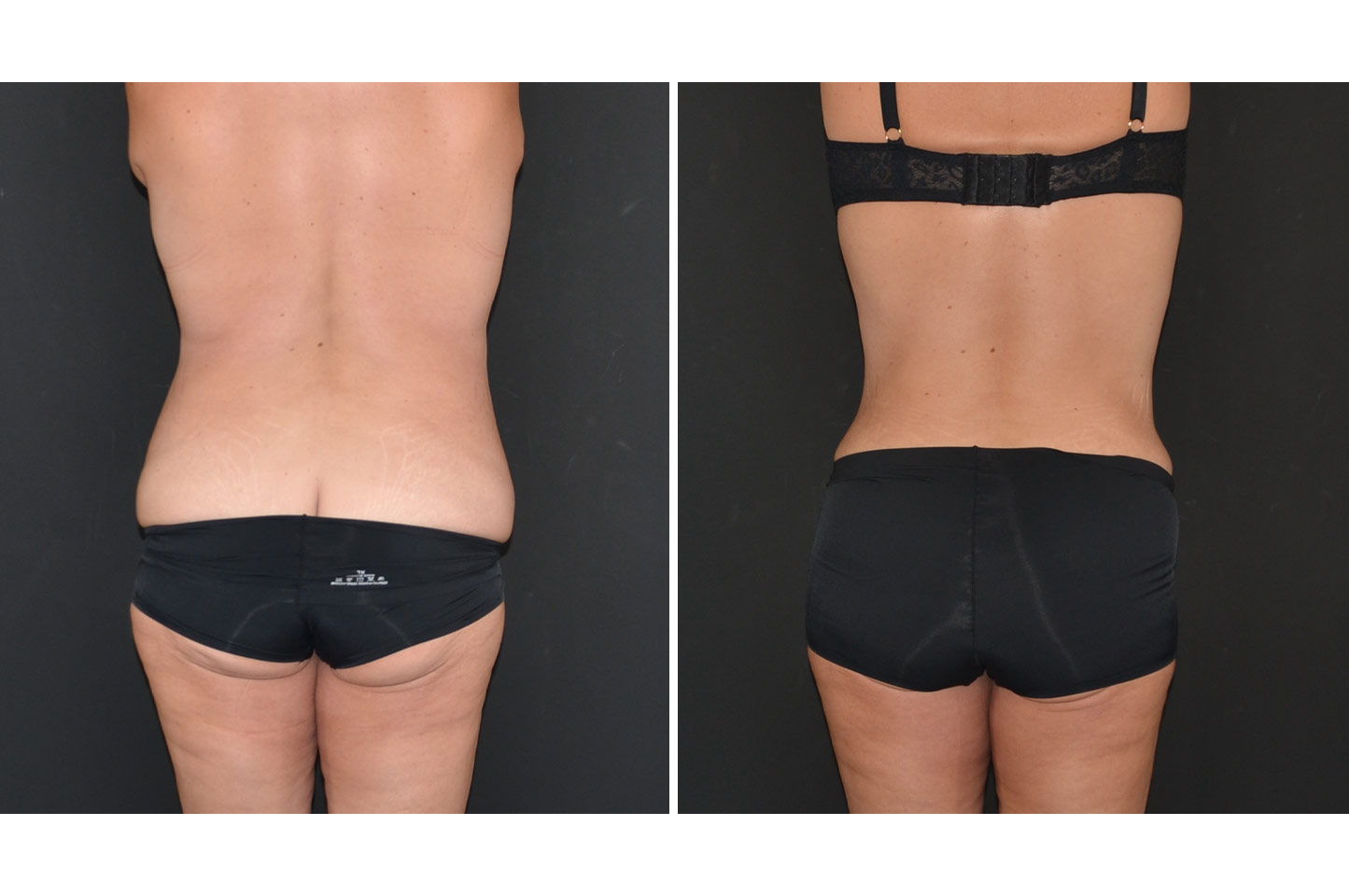 gallery-body-lift-c3