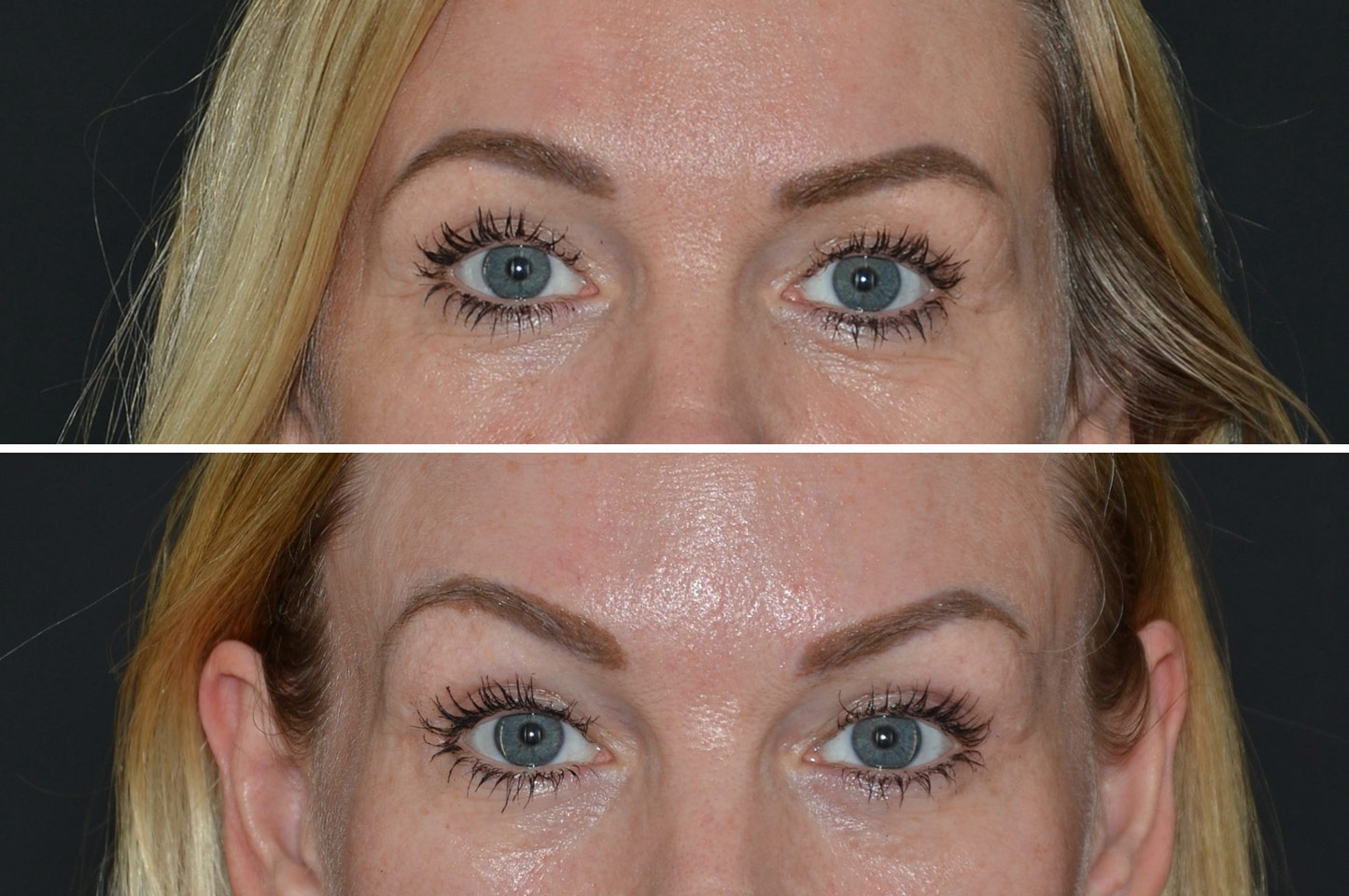 gallery-brow-lift-c1