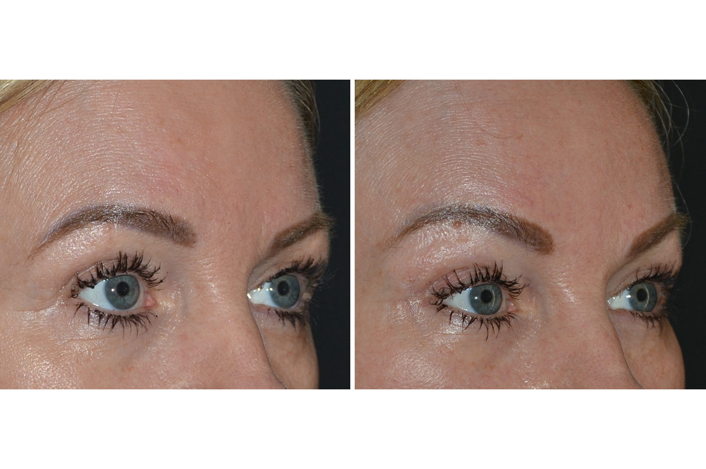 gallery-brow-lift-c3