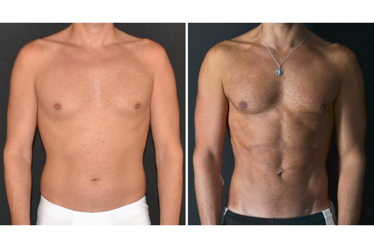 PAL® High Definition Liposculpture gallery-pal-hd-a1
