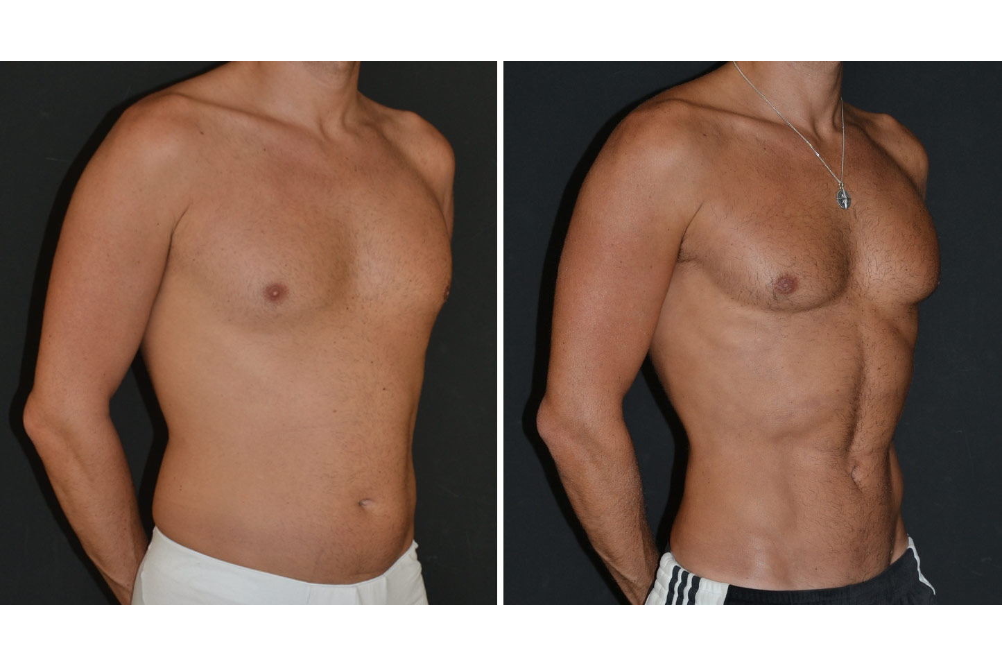 PAL® High Definition Liposculpture gallery-pal-hd-a2