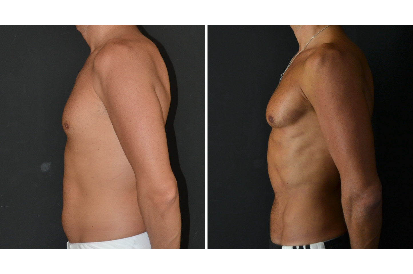 PAL® High Definition Liposculpture gallery-pal-hd-a3