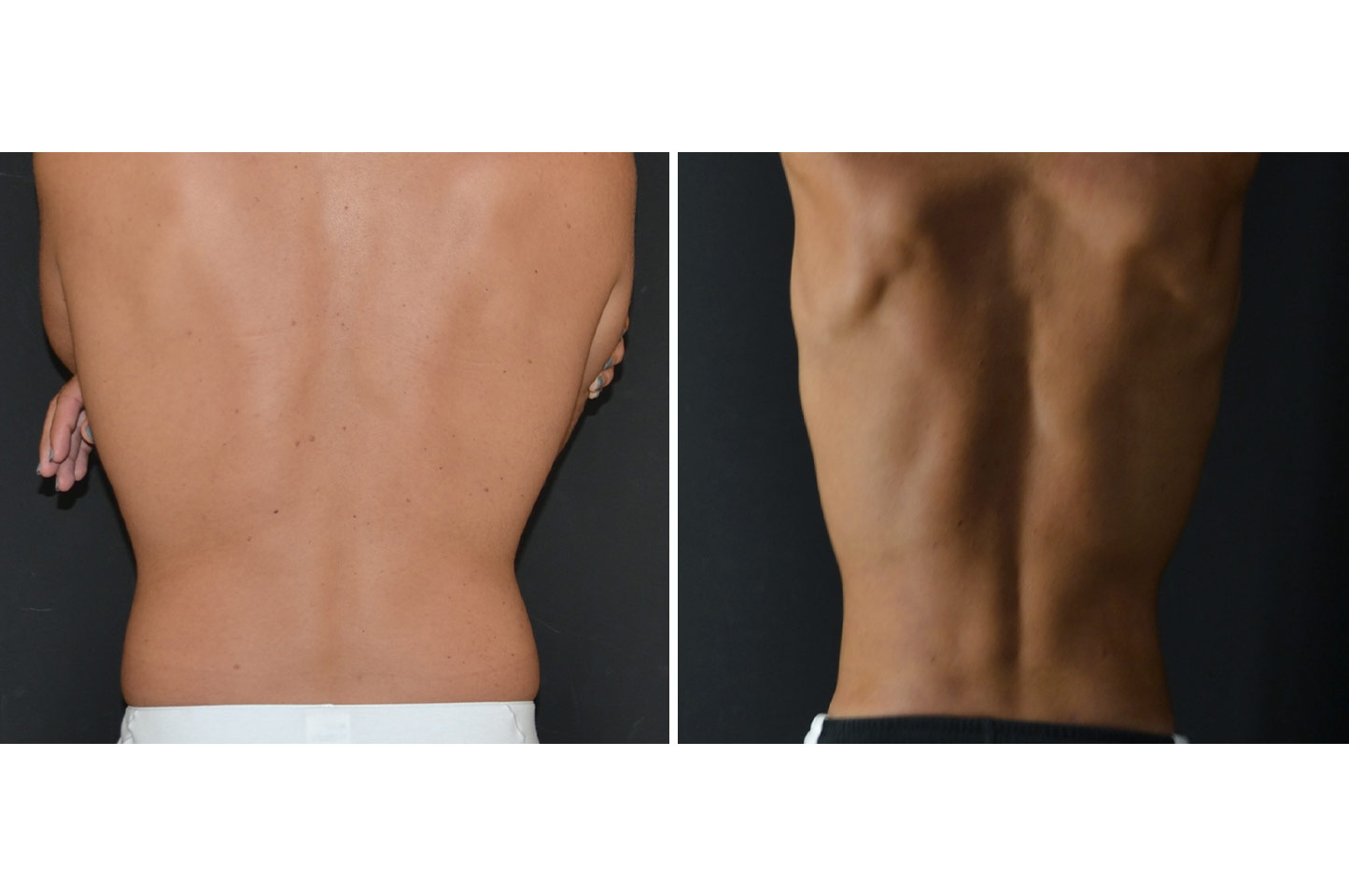 PAL® High Definition Liposculpture gallery-pal-hd-a4