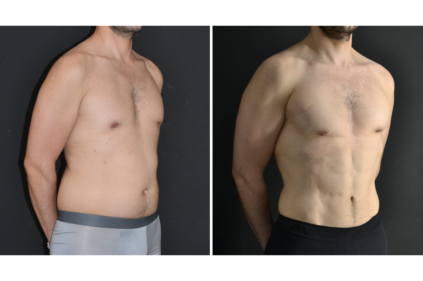 PAL® High Definition Liposculpture pal-hd-m-a1
