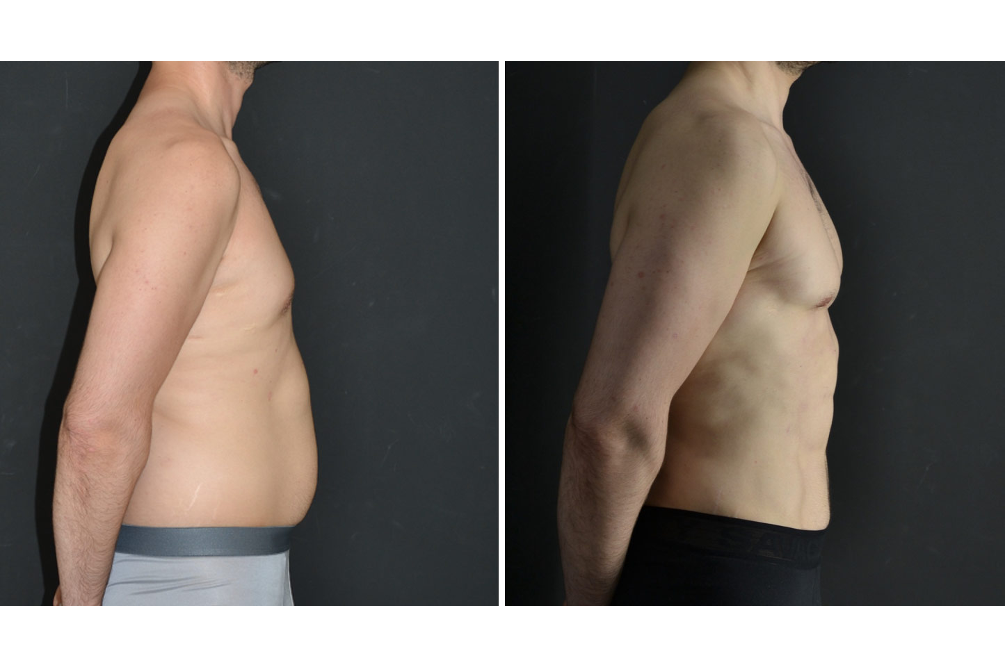 PAL® High Definition Liposculpture pal-hd-m-a2