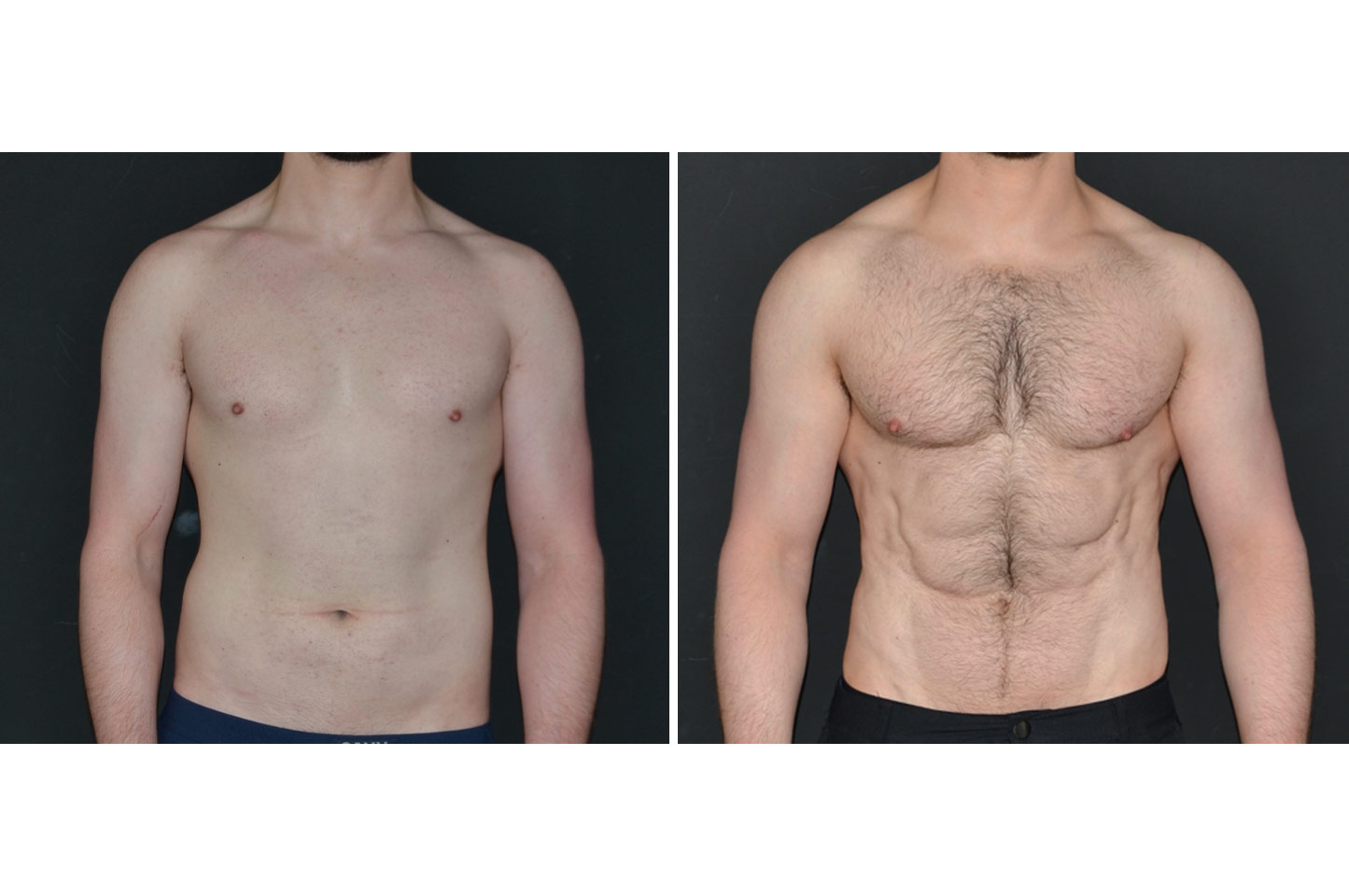 PAL® High Definition Liposculpture pal-hd-m-a3