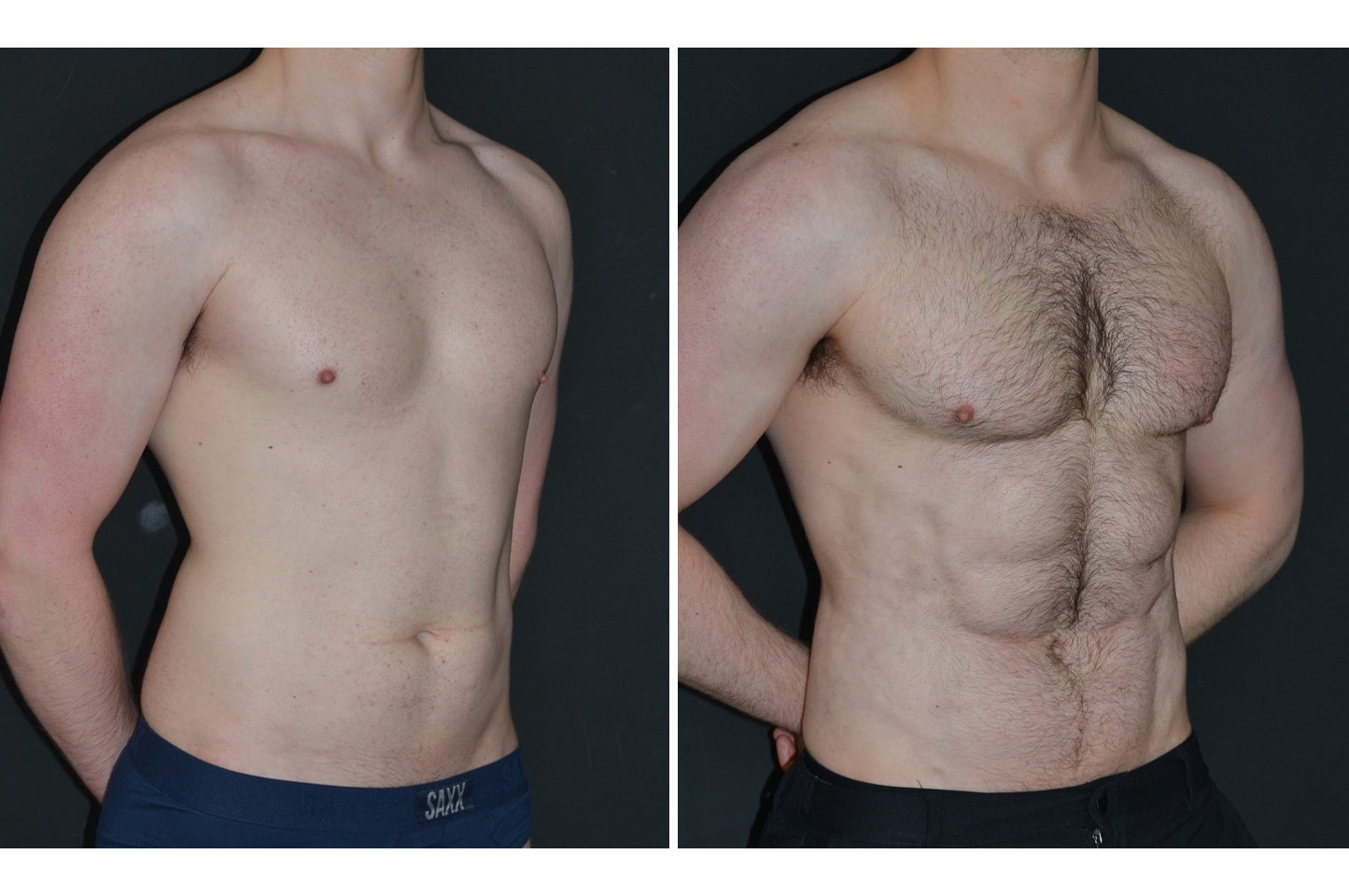 PAL® High Definition Liposculpture pal-hd-m-a4