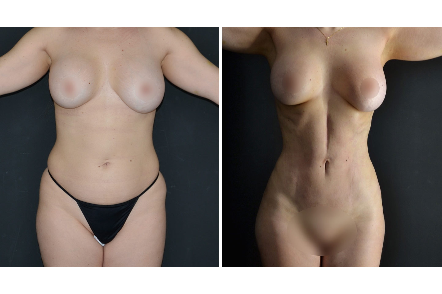 PAL® High Definition Liposculpture pal-hd-w-a1