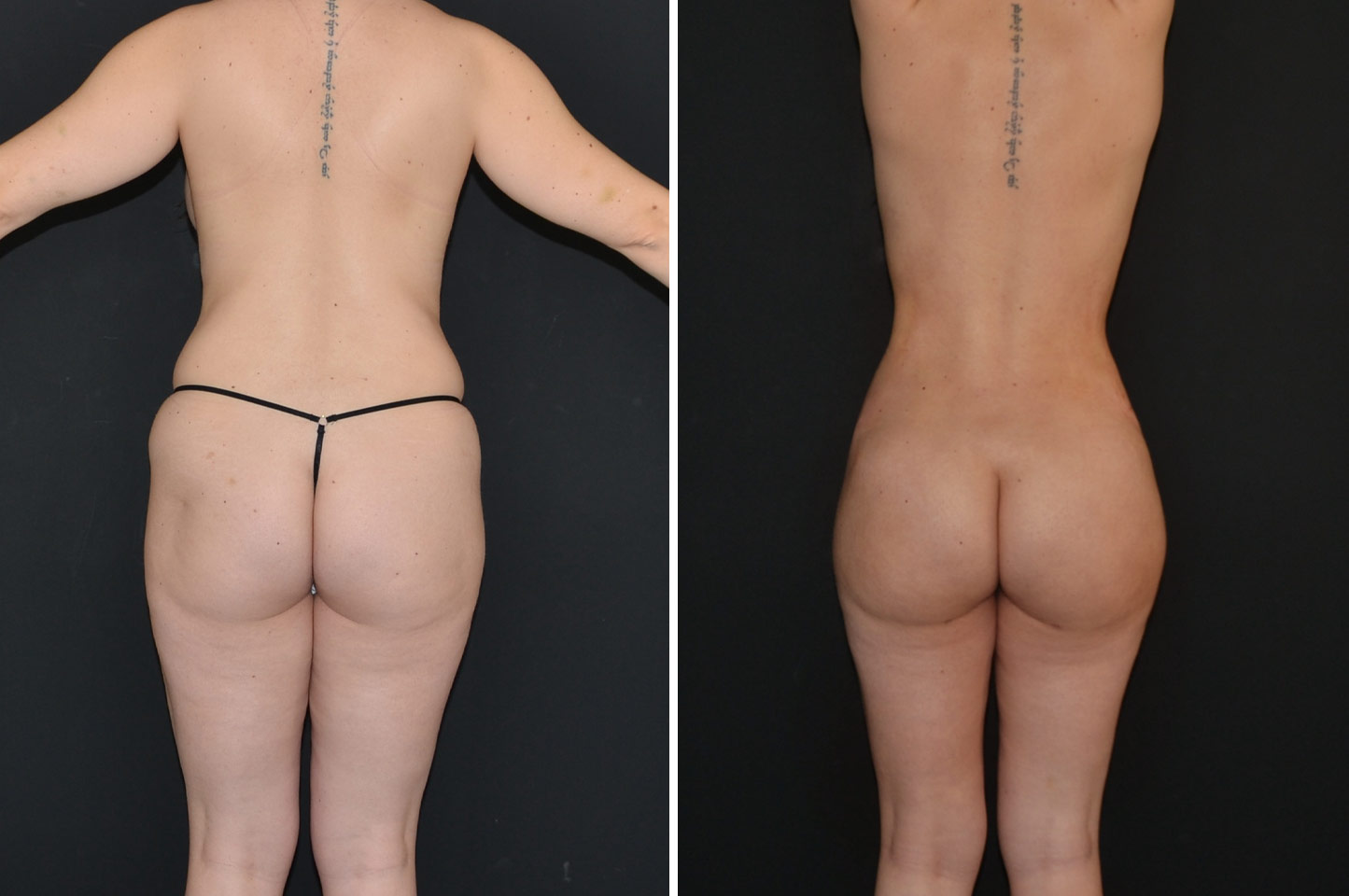 PAL® High Definition Liposculpture pal-hd-w-a3