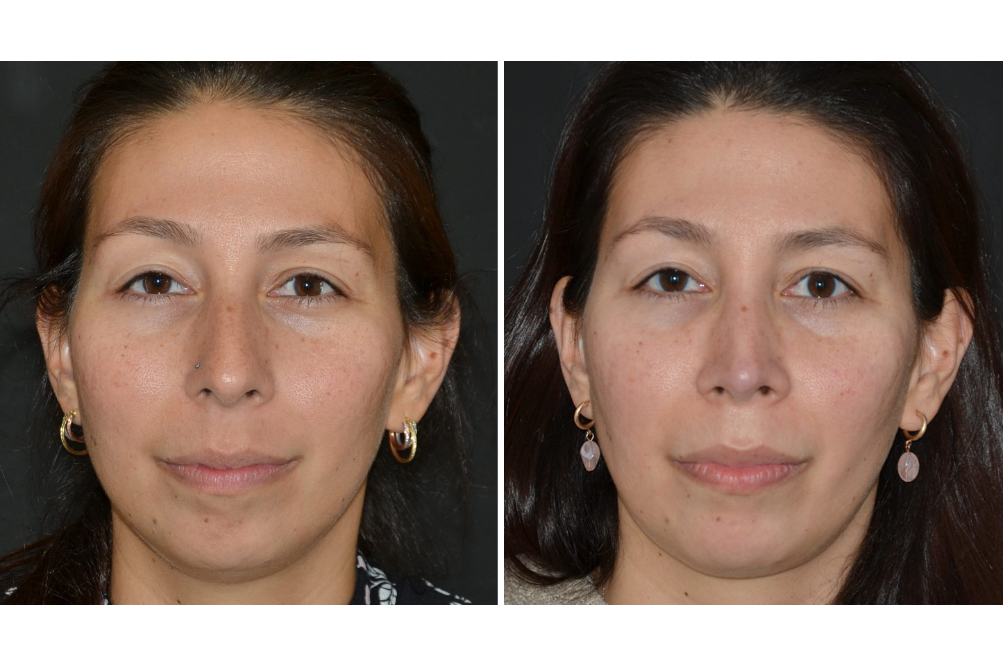 rhinoplasty-a1