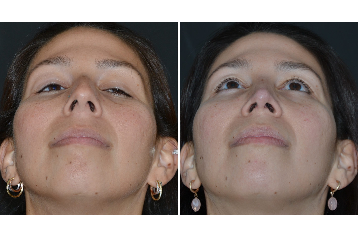 rhinoplasty-a2