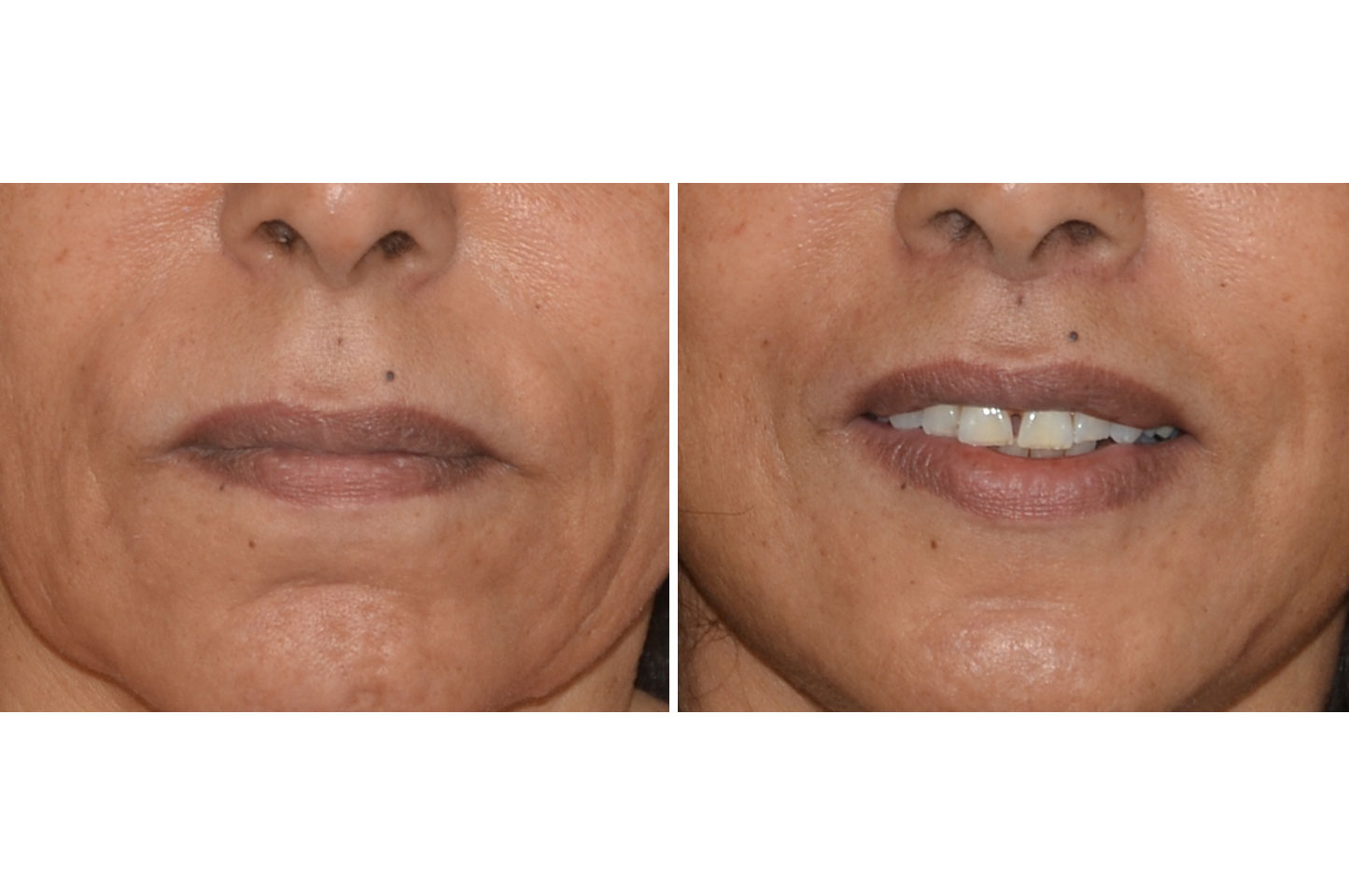 upper-lip-lift-a1