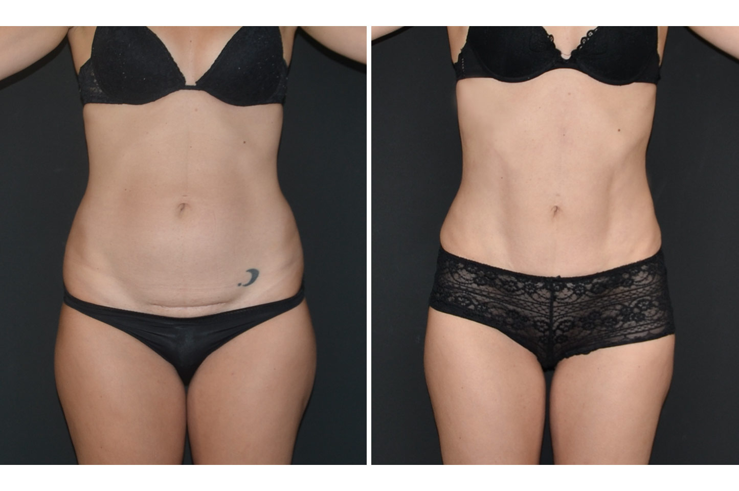 abdominoplasty-w-a1