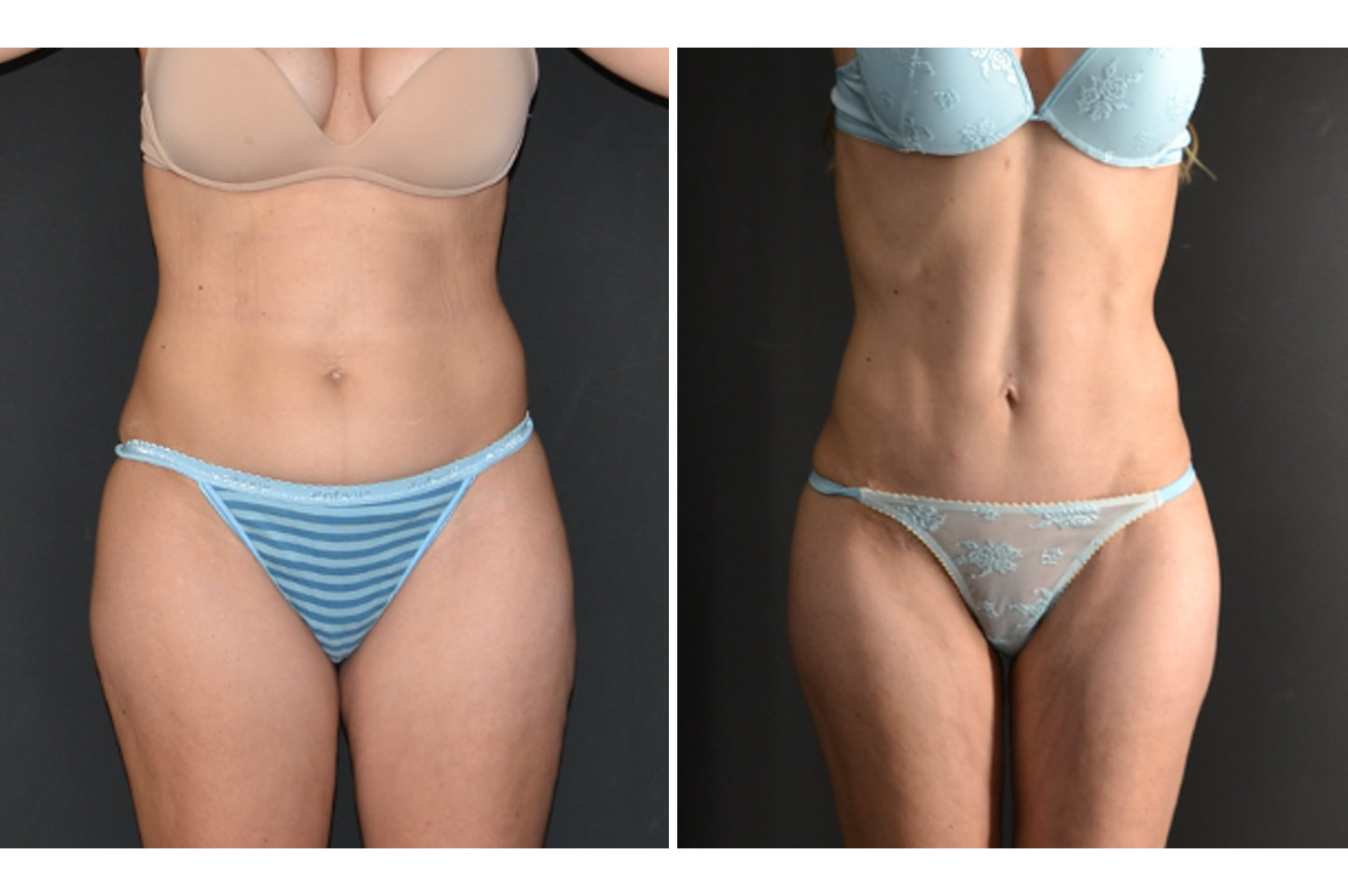 abdominoplasty-w-b1